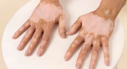 ¿Cómo pigmentar la piel si padeces vitiligo? Este es el mejor tratamiento