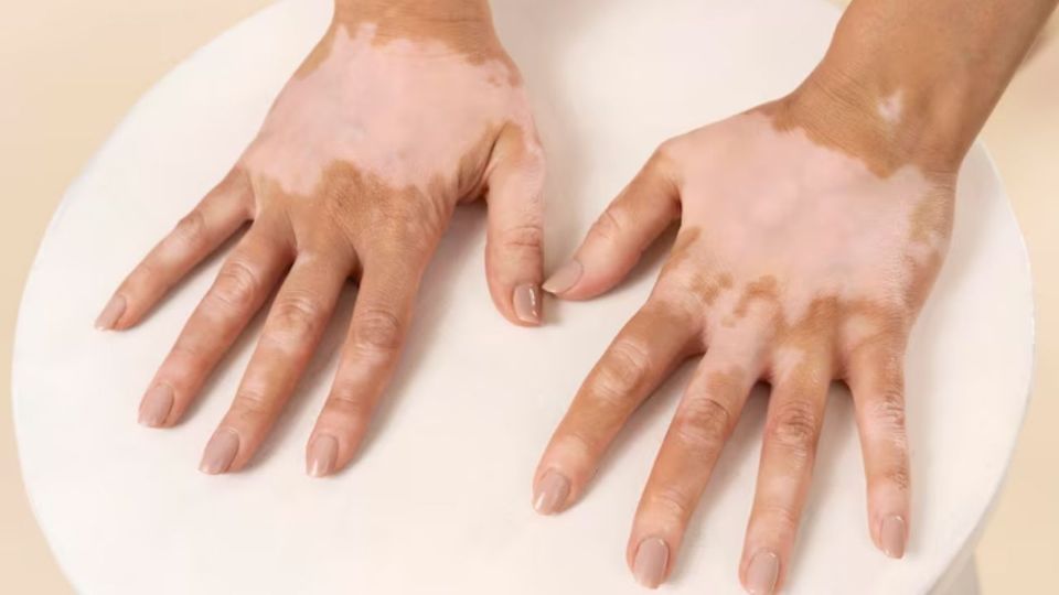 La ciencia avanzó y hay tratamientos efectivos para tratar el vitiligo.