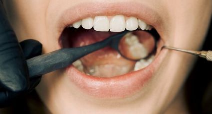 ¿Cómo eliminar el sarro de los dientes?