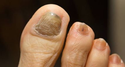 ¿Cómo eliminar los hongos de las uñas de los pies?