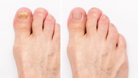 ¿Cómo quitar lo amarillo de las uñas de los pies?